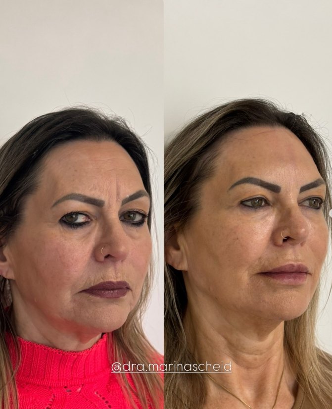 Antes e depois de harmonização facial: contorno do terço inferior e linhas de expressão suavizadas