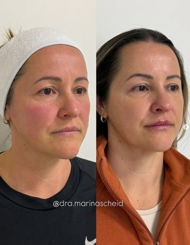 Antes e depois de preenchimento facial: definição de contorno e pele mais uniforme