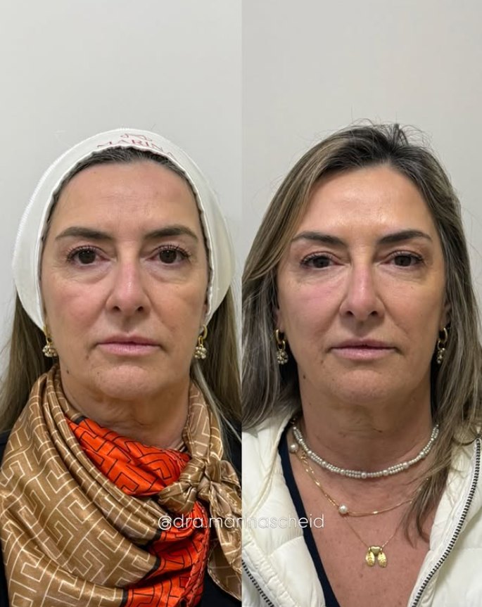 Antes e depois de harmonização facial: sustentação do terço médio e olhar mais descansado