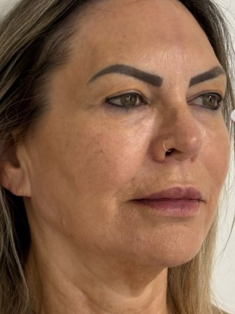 Paciente após aplicação de toxina botulínica