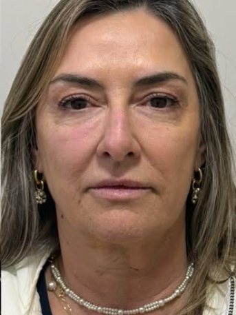 Paciente após harmonização facial na clínica Marina Scheid