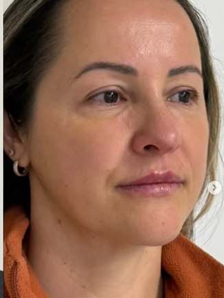 Paciente após preenchimento facial